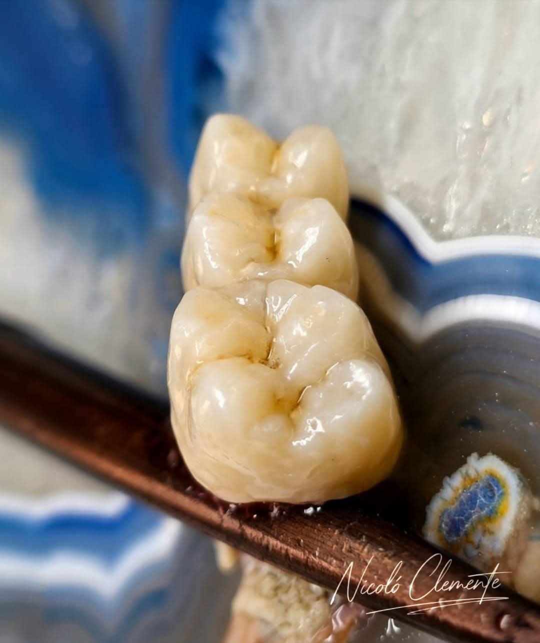 Corone posteriori in ceramica caratterizzate